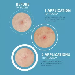 Iroha Patches SOS Brufoli – Azione Rapida in 8 Ore Iroha Patches SOS Brufoli – Azione Rapida in 8 Ore
